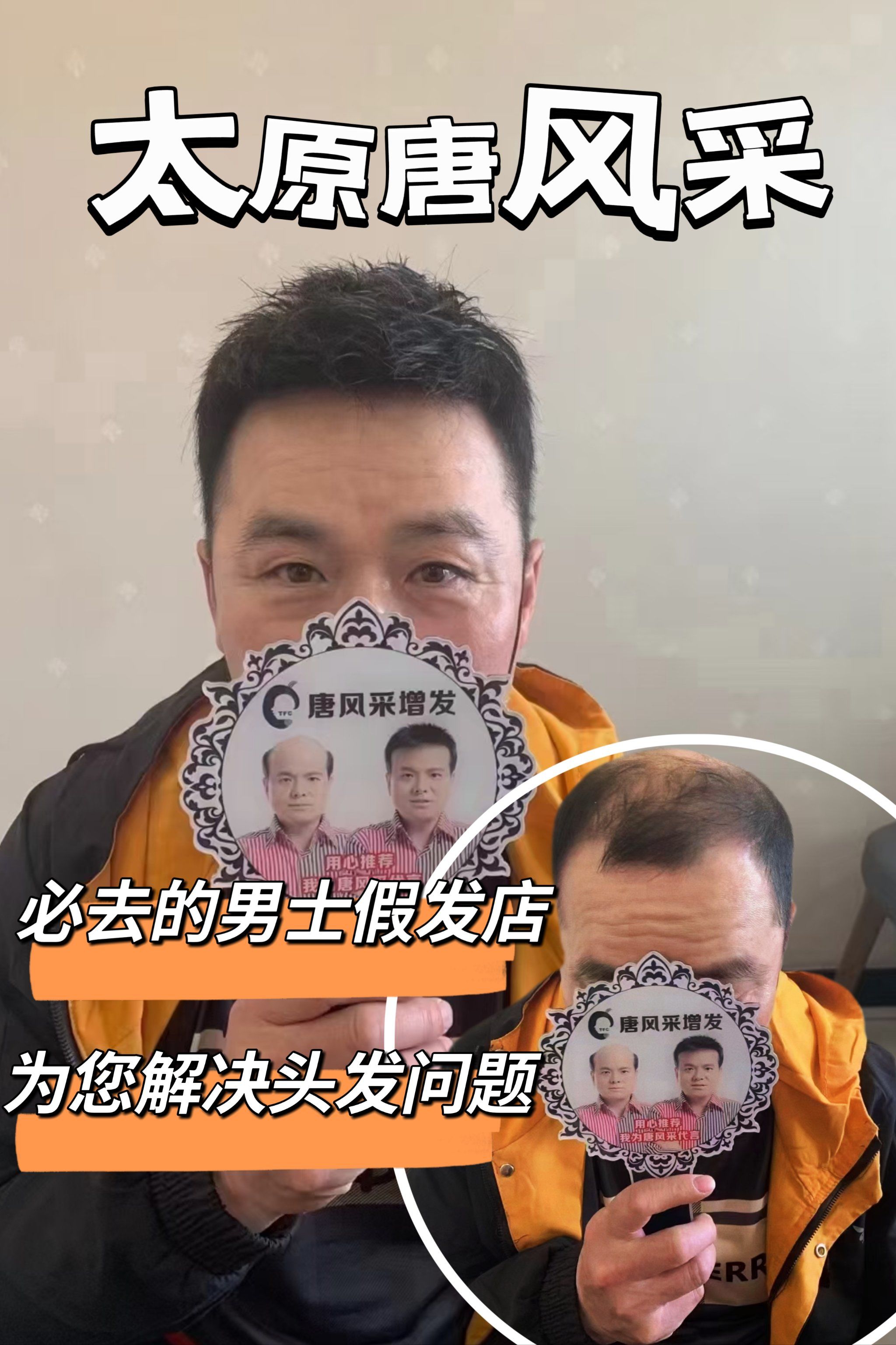 植发效果大揭秘