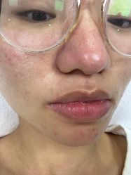 体验后-元熙兰积皮肤管理