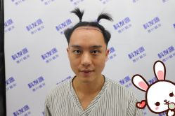 点击看大图 -大麦微针植发丨全国连锁