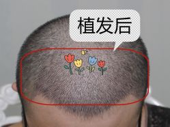 -大麦微针植发全国连锁