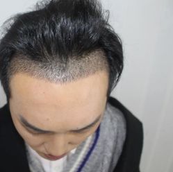 -大麦微针植发丨全国连锁