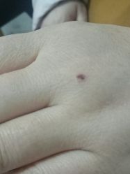 -痣清宫祛斑祛痣连锁店