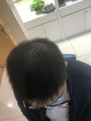 -大麦微针植发丨全国连锁
