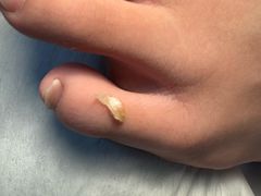 -世龙世家灰指甲鸡眼脚气甲沟炎跖疣护理(通州店)