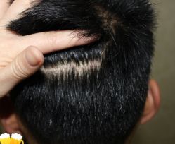 -大麦微针植发丨全国连锁