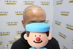 -大麦微针植发丨全国连锁