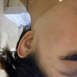 体验后-洁铭新加坡医美