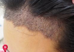 -大麦微针植发丨全国连锁