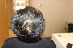 -大麦微针植发丨全国连锁