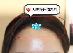 -大麦微针植发全国连锁