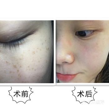 皮肤比之前细腻、白皙了很多，期下一次的效果