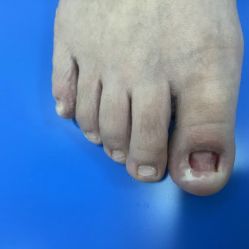 -德哥灰指甲脚气甲沟炎跖疣护理