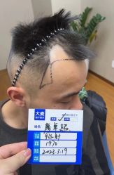 -大麦微针植发全国连锁