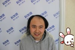 -大麦微针植发丨全国连锁