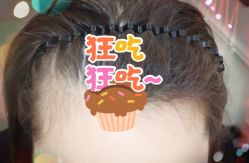 -大麦微针植发全国连锁