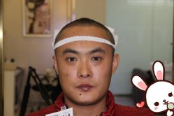 点击看大图 -大麦微针植发丨全国连锁