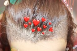 -大麦微针植发全国连锁