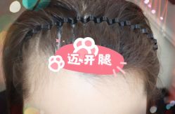 -大麦微针植发全国连锁