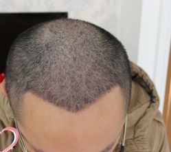 -大麦微针植发丨全国连锁