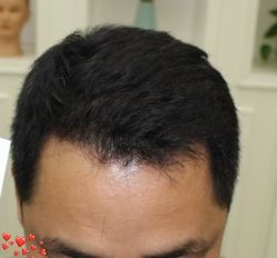 -大麦微针植发丨全国连锁