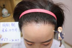 -大麦微针植发丨全国连锁