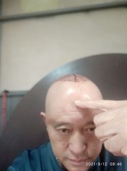 点击看大图 -新生植发·植养护一体