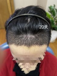 体验后-大麦微针植发全国连锁