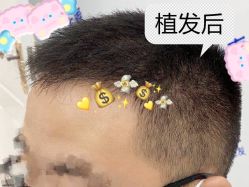 -大麦微针植发全国连锁