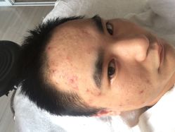 -苗方清颜专业祛痘