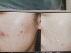 体验后-苑苑vbeauty科技美容SPA