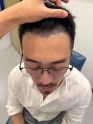 -大麦微针植发全国连锁