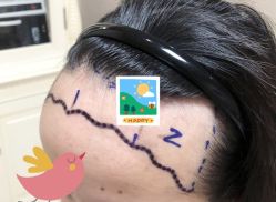 -大麦微针植发全国连锁