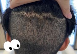 -大麦微针植发全国连锁