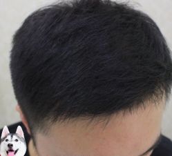 -大麦微针植发丨全国连锁