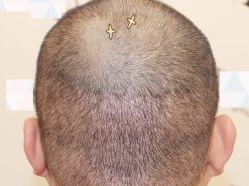 -大麦微针植发全国连锁