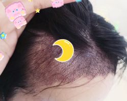 -大麦微针植发全国连锁