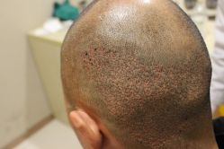 点击看大图 -大麦微针植发丨全国连锁