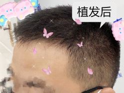 -大麦微针植发全国连锁