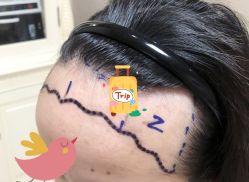 -大麦微针植发全国连锁