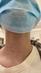 体验后-广州健丽·去眼袋医疗美容机构