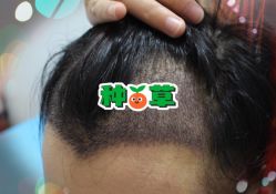 -大麦微针植发全国连锁