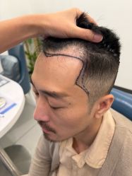 -大麦微针植发全国连锁