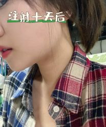 体验后-苏州维多利亚美容医院