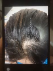 -碧莲盛·不剃发植发