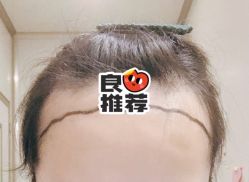 -大麦微针植发全国连锁