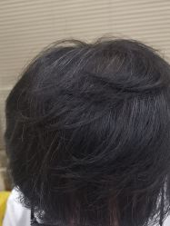 -大麦微针植发丨全国连锁