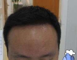 -大麦微针植发丨全国连锁