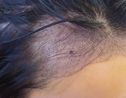 -大麦微针植发全国连锁