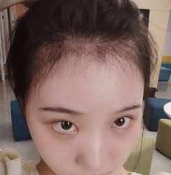 -碧莲盛·不剃发植发