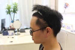 点击看大图 -大麦微针植发丨全国连锁